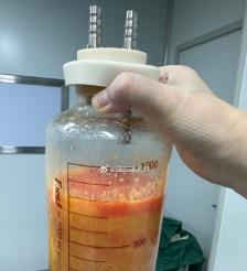 山西水动力吸脂手术要做多久？